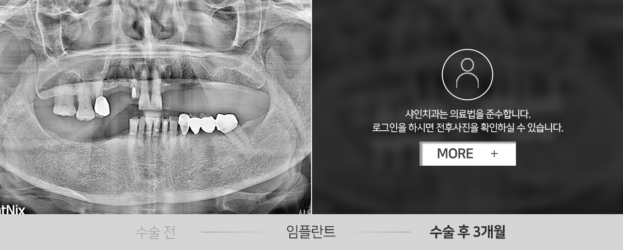 임플란트-전후사진1