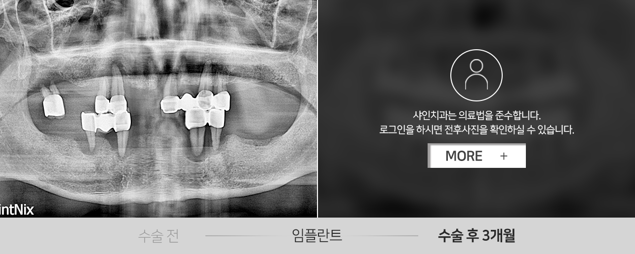 임플란트-전후사진2