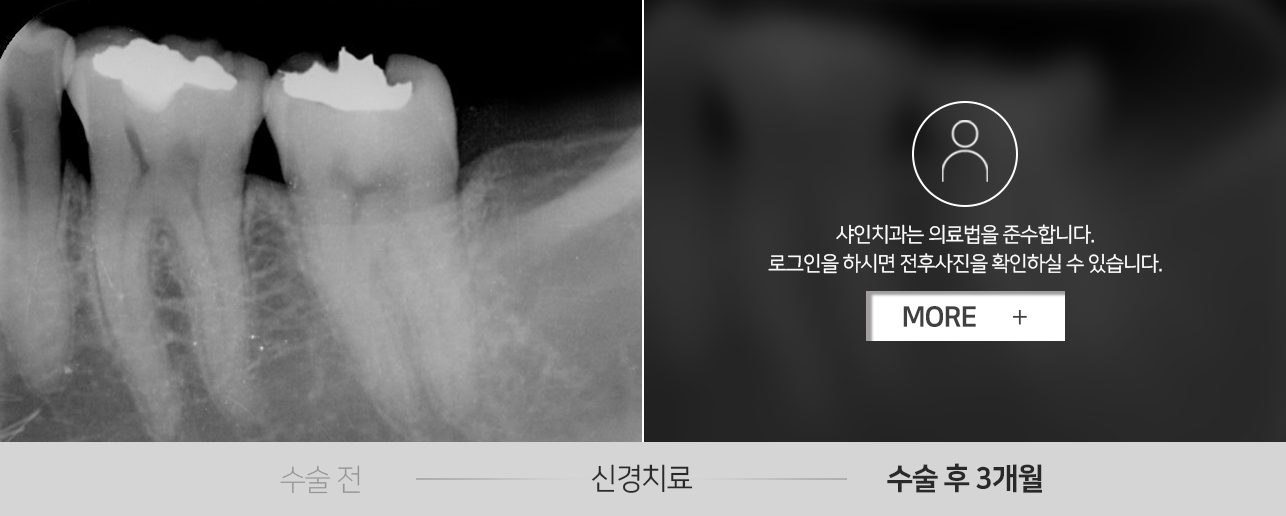 신경치료-전후사진2