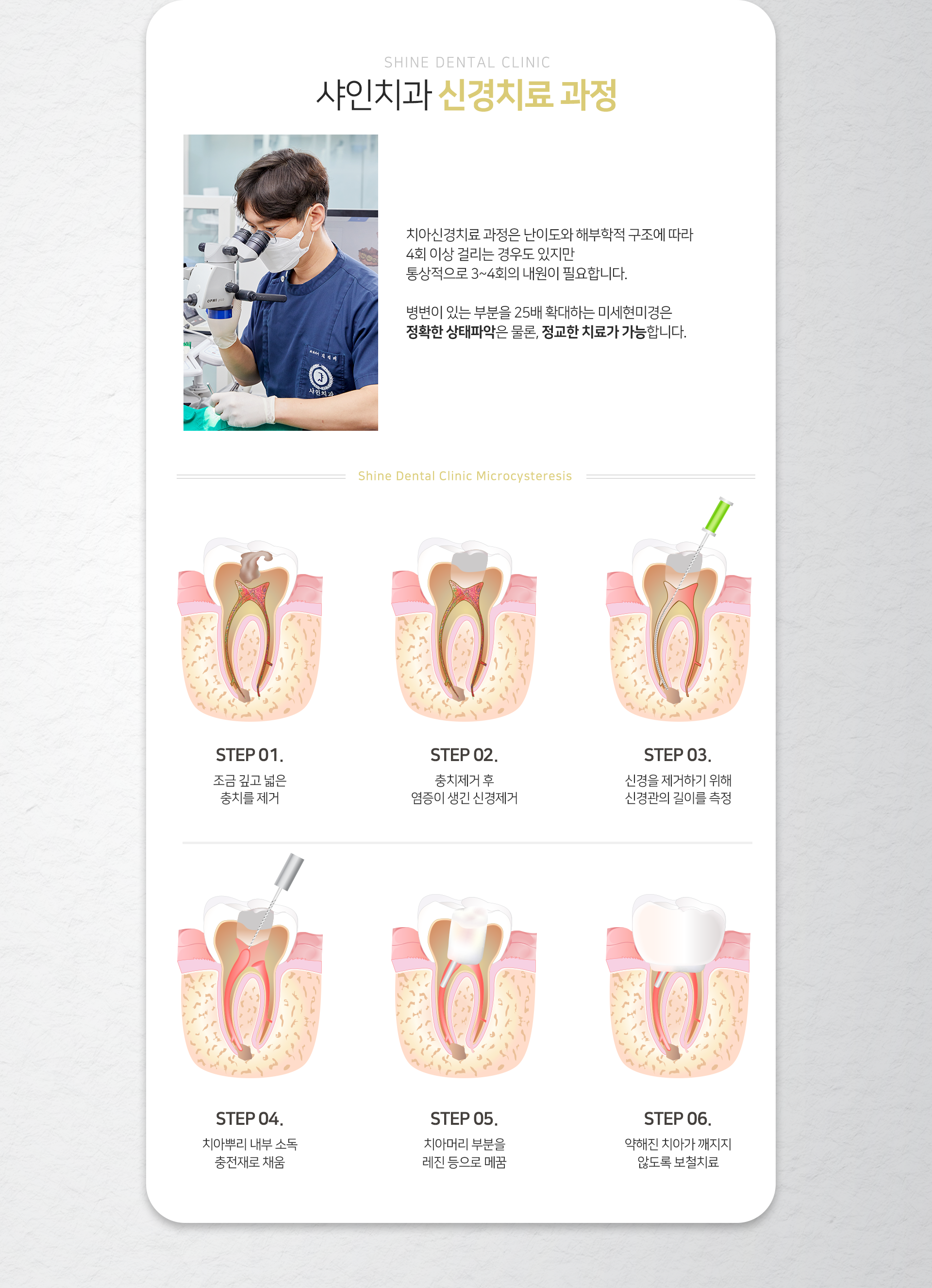 신경치료-과정-1단계-조금-깊고-넓은-충치를-제거-2단계-충치-제거-후-염증이-생긴-신경-제거-3단계-신경을-제거하기-위해-신경관의-길이를-측정-4단계-치아-뿌리-내부-소독-충전재로-채움-5단계-치아머리-부분을-레진-등으로-메꿈-6단계-약해진-치아가-깨지지-않도록-보철치료