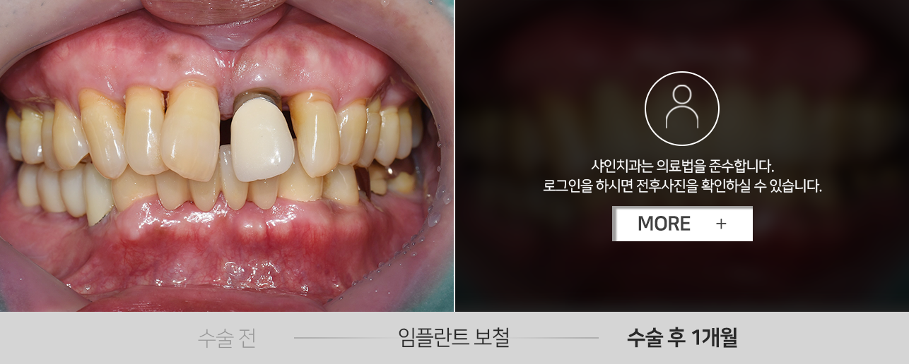 임플란트-보철-전후사진1