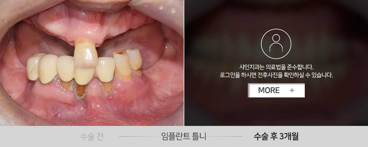 임플란트-틀니-전후사진1