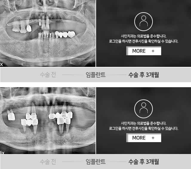 임플란트-전후사진
