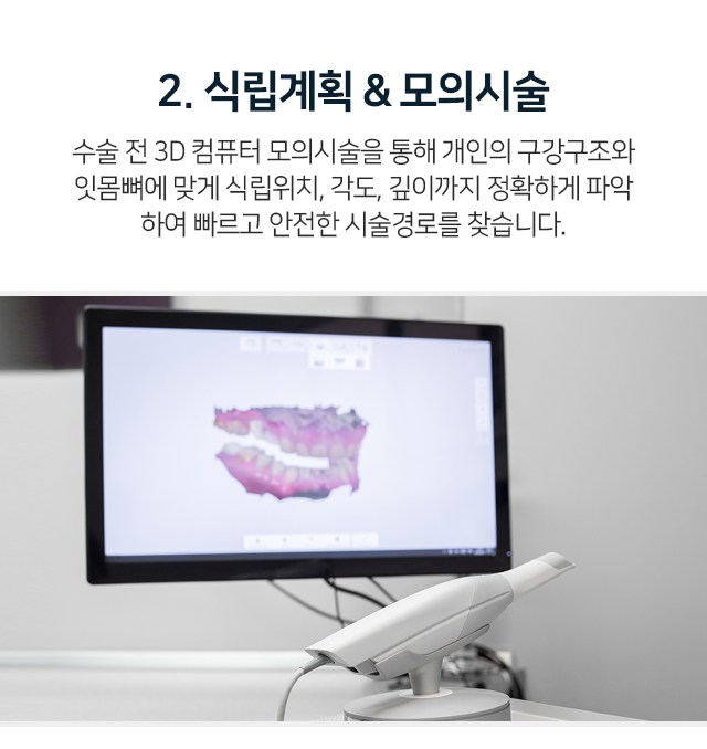 2단계-수술-전-3D-컴퓨터-모의-시술을-통해-개인의-구강구조와-잇몸뼈에-맞게-식립-위치-각도-깊이까지-정확하게-파악하여-빠르고-안전한-시술-경로를-찾습니다