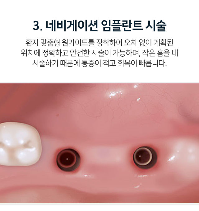 3단계-환자-맞춤형-원가이드를-장착하여-오차-없이-계획된-위치에-정확하고-안전한-시술이-가능하며-작은-홈을-내-시술하기-때문에-통증이-적고-회복이-빠릅니다