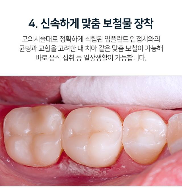 4단계-모의-시술대로-정확하게-식립된-임플란트-인접치와의-균형과-교합을-고려한-내-치아-같은-맞춤-보철이-가능해-바로-음식-섭취-등-일상생활이-가능합니다