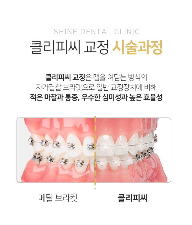 클리피씨-교정-시술-과정