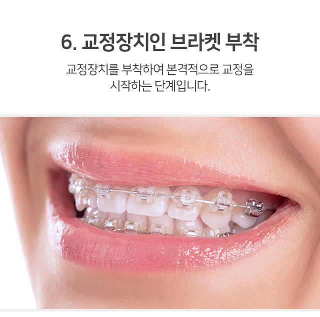 6단계-교정장치인-브라켓-부착-교정장치를-부착하여-본격적으로-교정을-시작하는-단계입니다