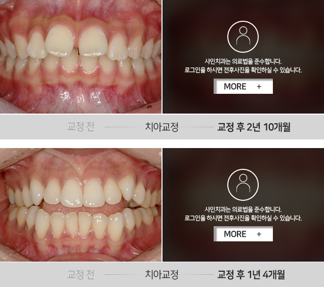 치아교정-전후사진