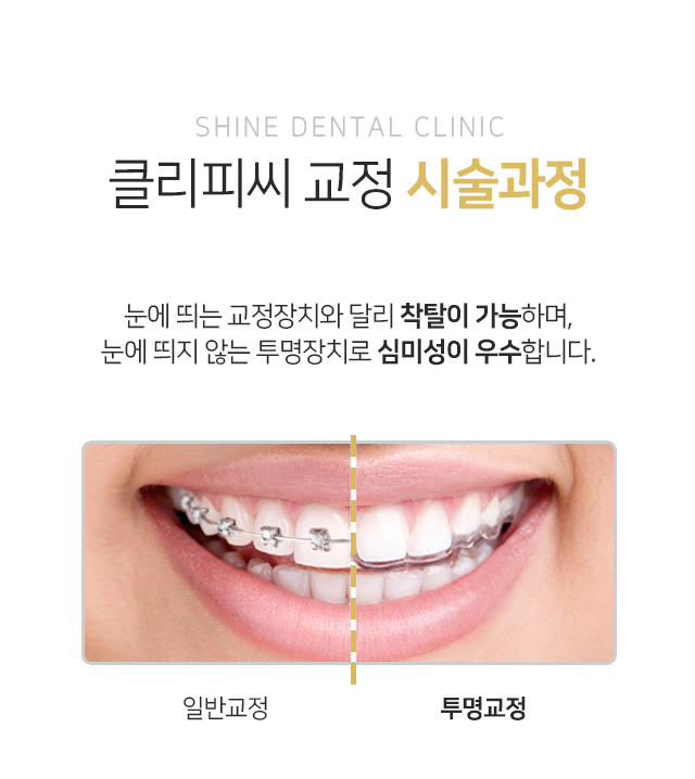 투명교정-제작-과정