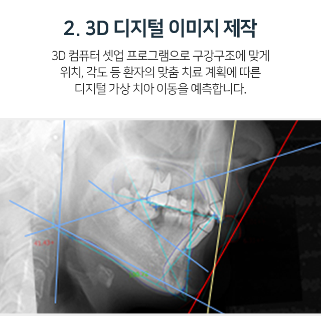 2단계-3D-디지털-이미지-제작-3D-컴퓨터-셋업-프로그램으로-구강구조에-맞게-위치-각도-등-환자의-맞춤-치료-계획에-따른-디지털-가상-치아-이동을-예측합니다