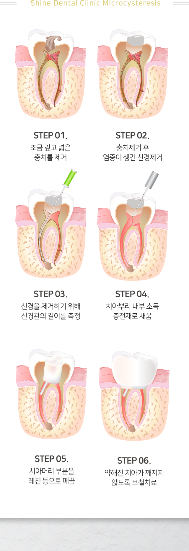 1단계-조금-깊고-넓은-충치를-제거-2단계-충치-제거-후-염증이-생긴-신경-제거-3단계-신경을-제거하기-위해-신경관의-길이를-측정-4단계-치아-뿌리-내부-소독-충전재로-채움-5단계-치아머리-부분을-레진-등으로-메꿈-6단계-약해진-치아가-깨지지-않도록-보철치료