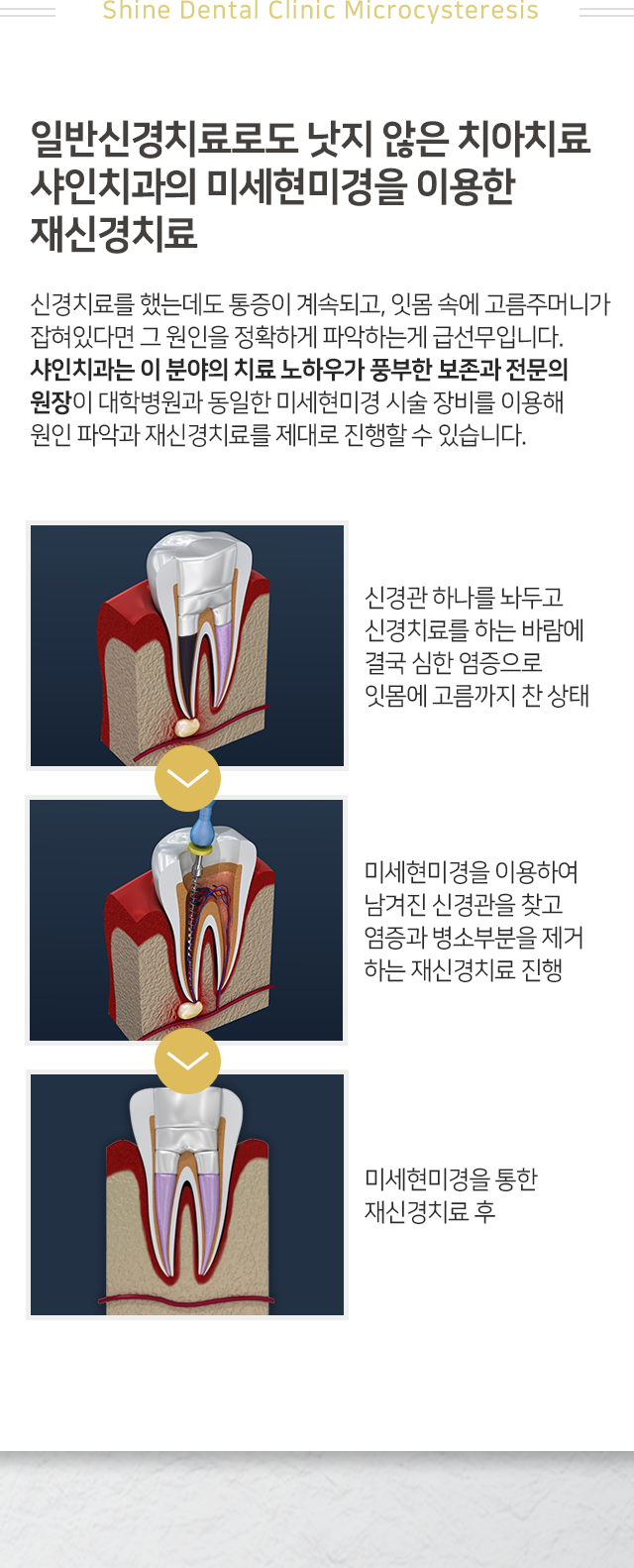 신경치료를-했는데도-통증이-계속되고-잇몸-속에-고름-주머니가-잡혀있다면-그-원인을-정확하게-파악하는-게-급선무입니다-샤인치과는-이-분야의-치료-노하우가-풍부한-보존과-전문의-원장이-대학병원과-동일한-미세현미경-시술-장비를-이용해-원인-파악과-재신경치료를-진행합니다-재신경치료-과정-신경관-하나를-놔두고-신경치료를-하는-바람에-결국-심한-염증으로-잇몸에-고름까지-찬-상태-미세현미경을-이용하여-남겨진-신경관을-찾고-염증과-병소-부분을-제거하는-재신경치료-진행
