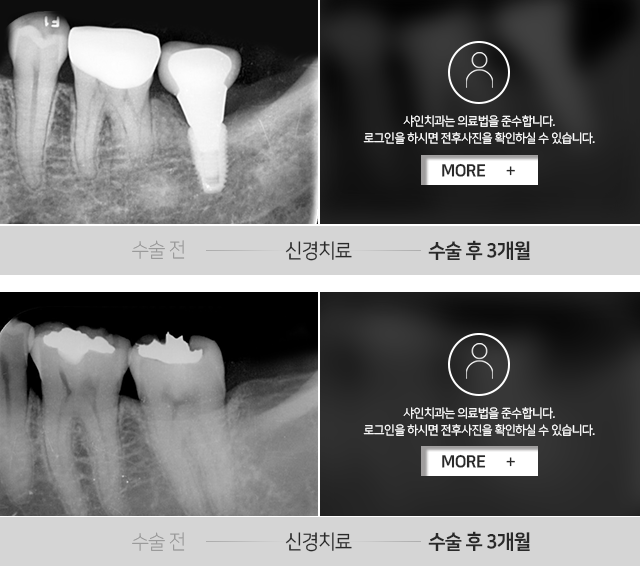 신경치료-전후사진