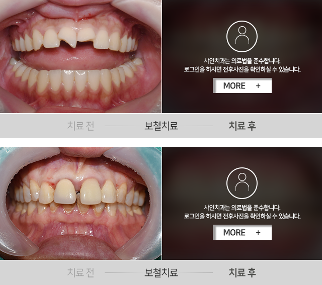 보철치료-전후사진
