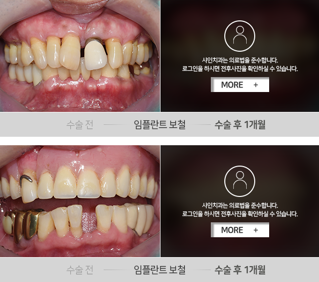 임플란트-보철-전후사진