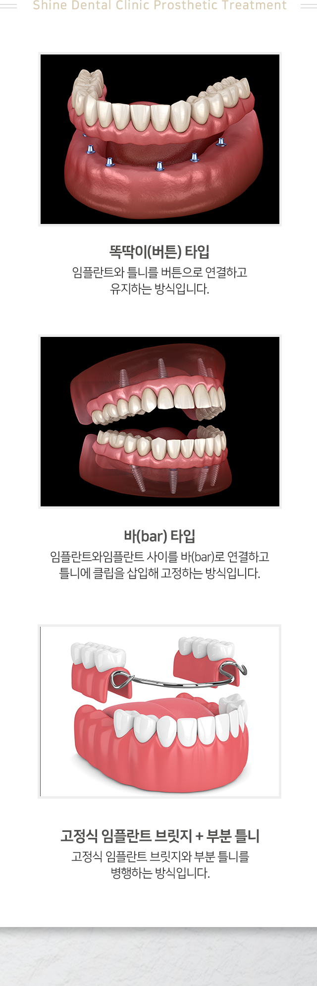똑딱이-버튼-타입-임플란트와-틀니를-버튼으로-연결하고-유지하는-방식입니다-바-타입-임플란트와-임플란트-사이를-바로-연결하고-틀니에-클립을-삽입해-고정하는-방식입니다-고정식-임플란트-브릿지-및-부분-틀니-고정식-임플란트-브릿지와-부분-틀니를-병행하는-방식입니다