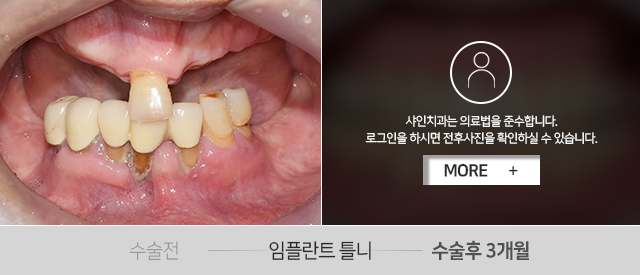 임플란트-틀니-전후사진