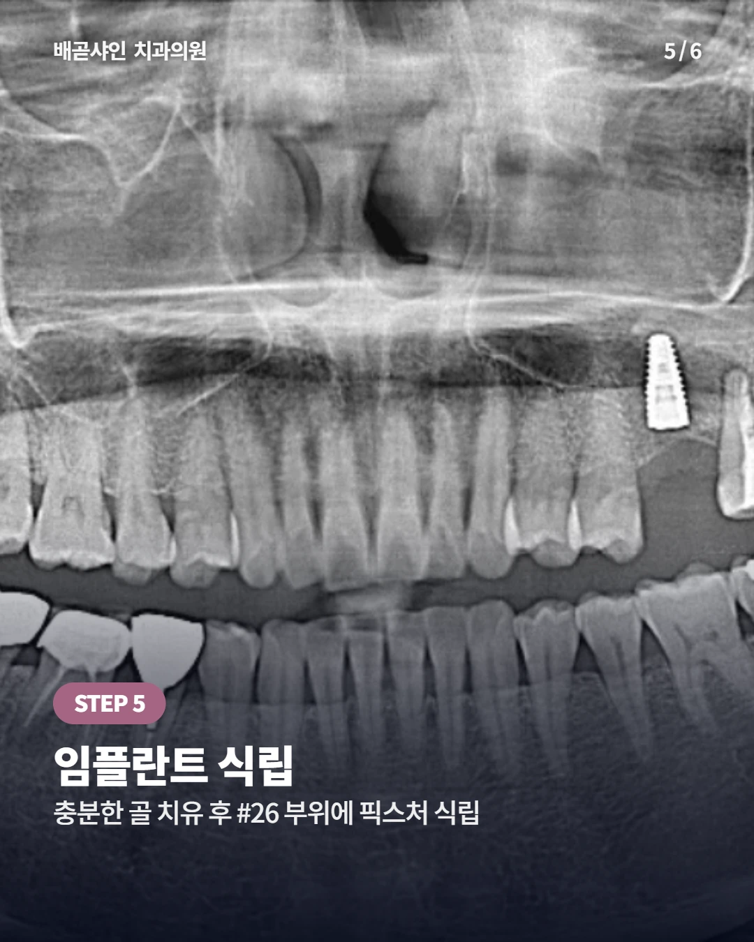 함치성낭종 #26 — 발치·낭포 적출 후 골이식·임플란트까지 (50대 사례)