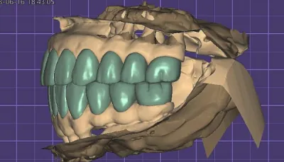 디지털 디자인 형태·교합 확인 관련 사진
