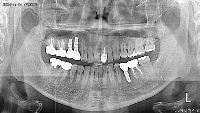 최종 보철 마무리 사진