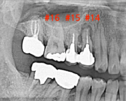 확대된 x-ray 치아 내부 사진