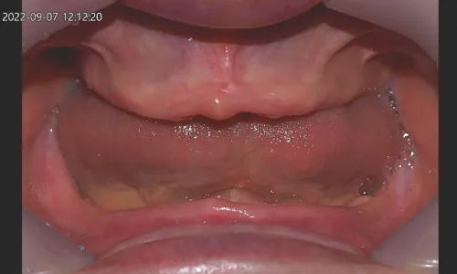 치료 전후 교합 상태 사진