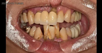 치료 전후 방사선 사진