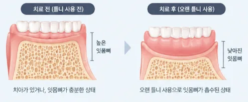 틀니와 잇몸뼈 흡수