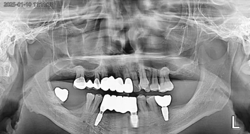 파노라마 X-ray, 보철 장착 관련 사진