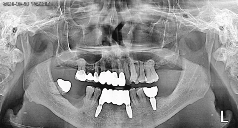 파노라마 X-ray, 보철 장착 후 경과 관찰 관련 사진