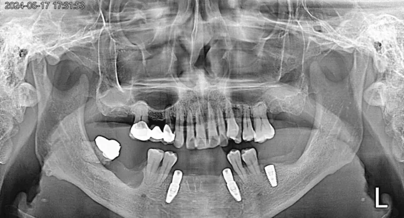 파노라마 X-ray, 1차 수술 후 관련 사진