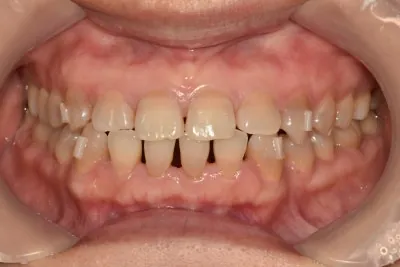교정 및 보철 치료 마무리 사진