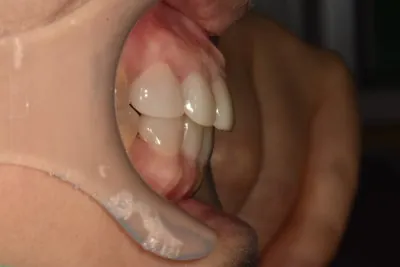 윗니(#13~23) 치료 관련 사진