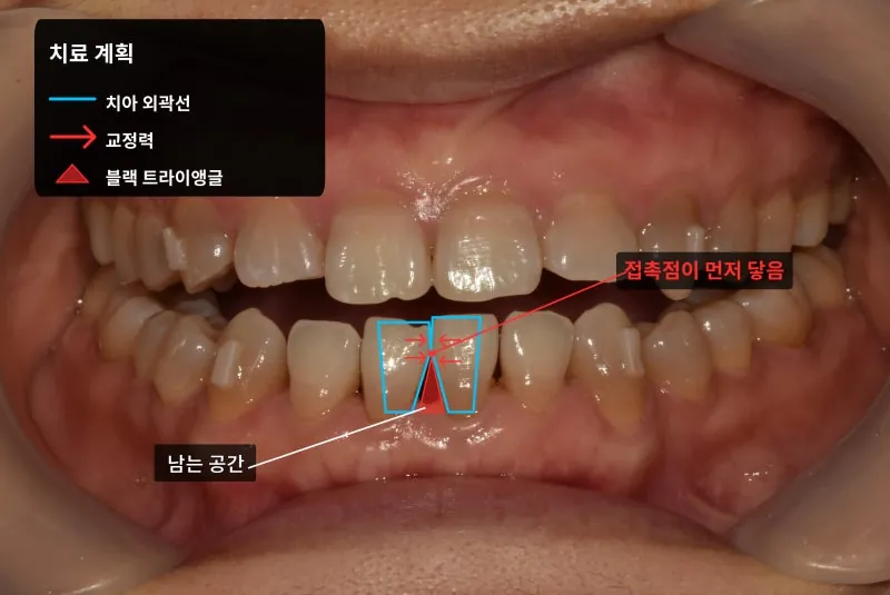 치아 뿌리 쪽 공간 관련 사진