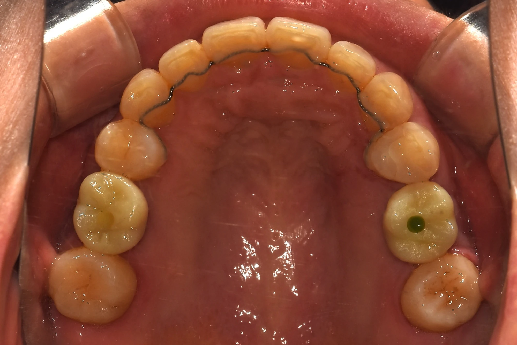 보철 및 유지장치 부착된 상악 교합면 사진